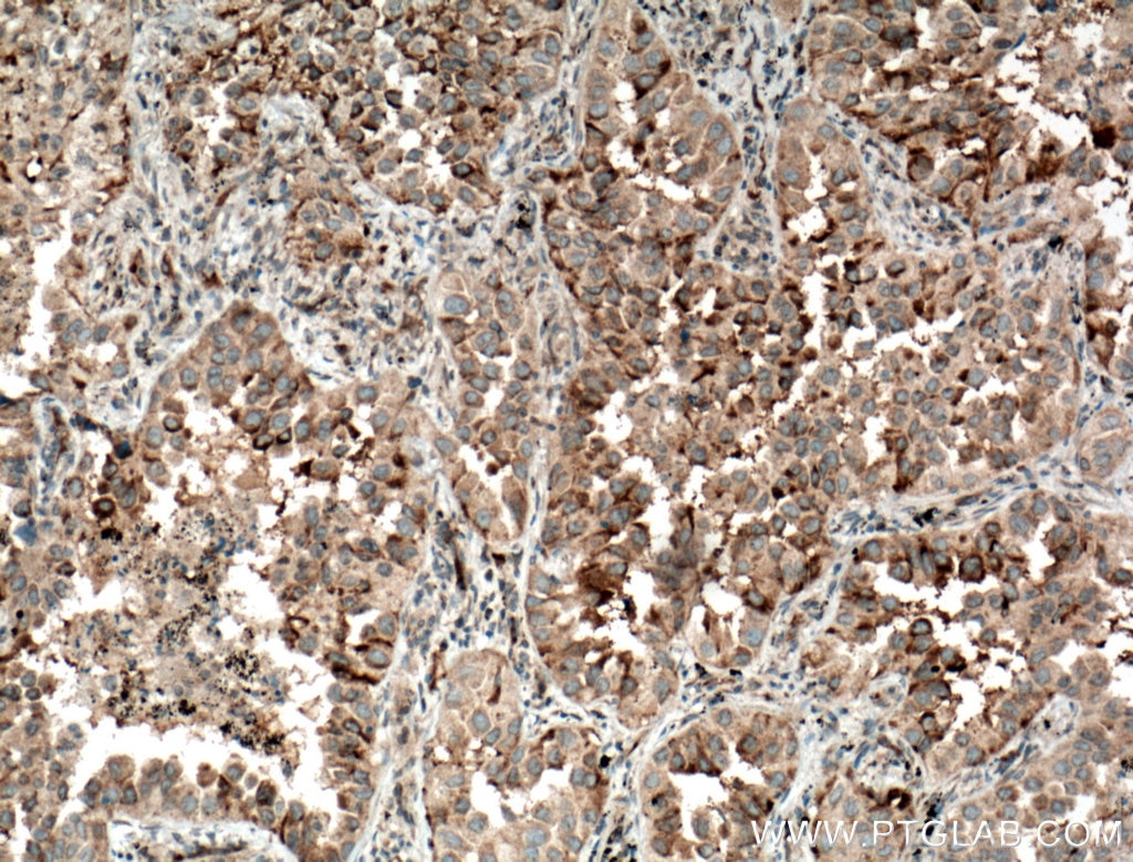 Immunohistochemistry (IHC) staining of human lung cancer tissue using ARHGEF10 Polyclonal antibody (11112-1-AP)