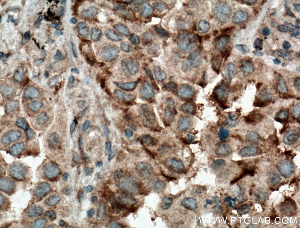 Immunohistochemistry (IHC) staining of human lung cancer tissue using ARHGEF10 Polyclonal antibody (11112-1-AP)
