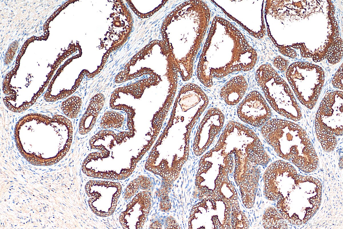 Immunohistochemistry (IHC) staining of human prostate cancer tissue using ARHGEF18 Polyclonal antibody (11243-1-AP)