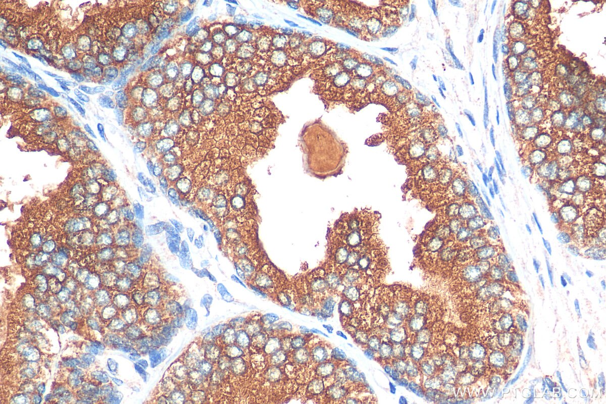 Immunohistochemistry (IHC) staining of human prostate cancer tissue using ARHGEF18 Polyclonal antibody (11243-1-AP)