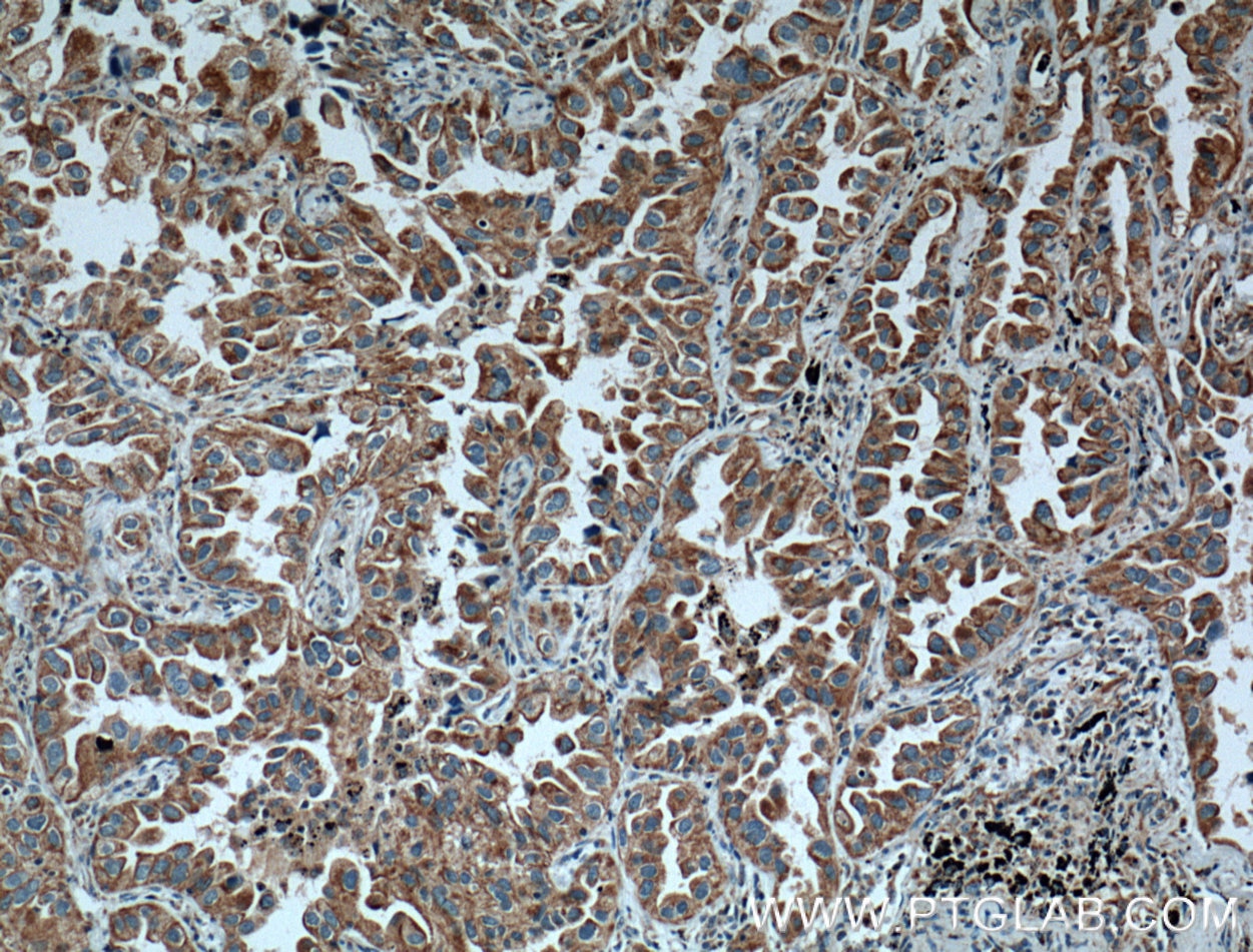 Immunohistochemistry (IHC) staining of human lung cancer tissue using ARHGEF5 Polyclonal antibody (11379-1-AP)