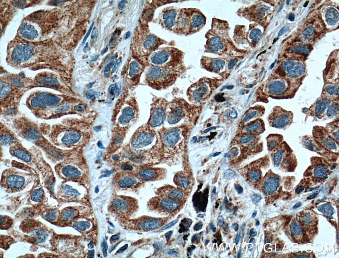 Immunohistochemistry (IHC) staining of human lung cancer tissue using ARHGEF5 Polyclonal antibody (11379-1-AP)