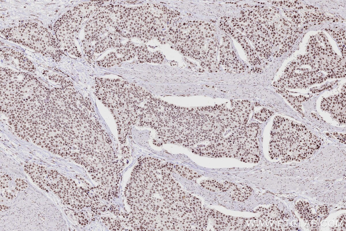 IHC staining of human stomach cancer using 82979-6-RR Immunohistochemistry (IHC) staining of human stomach cancer tissue using ARID1B Recombinant monoclonal antibody (82979-6-RR)