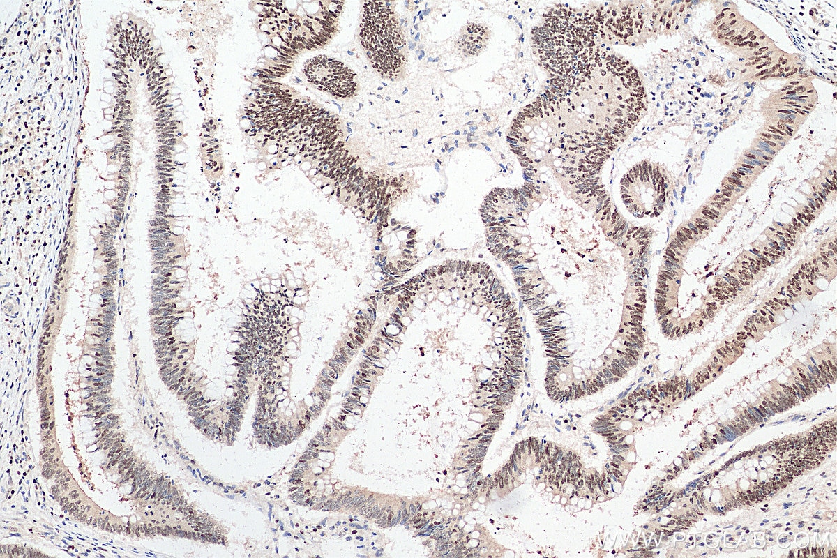 Immunohistochemistry (IHC) staining of human colon cancer tissue using ARID3A Polyclonal antibody (14068-1-AP)