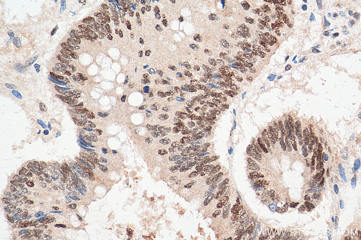 Immunohistochemistry (IHC) staining of human colon cancer tissue using ARID3A Polyclonal antibody (14068-1-AP)