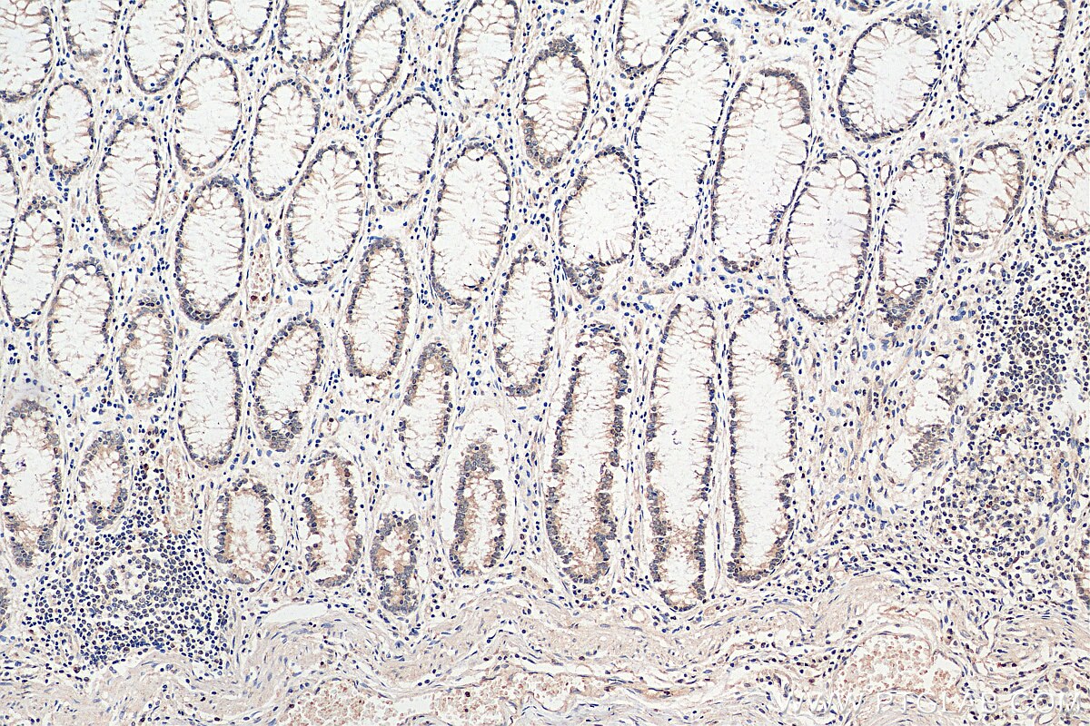 Immunohistochemistry (IHC) staining of human colon cancer tissue using ARID3A Polyclonal antibody (14068-1-AP)