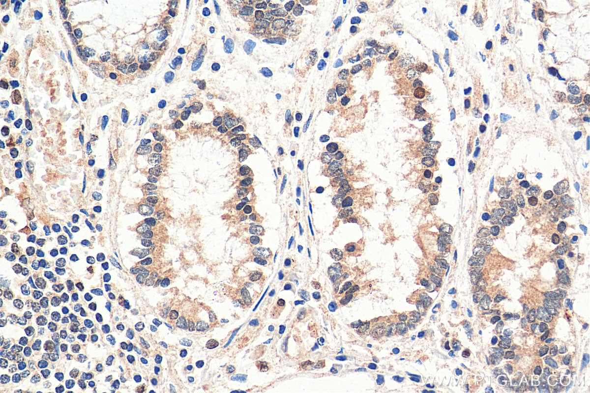 Immunohistochemistry (IHC) staining of human colon cancer tissue using ARID3A Polyclonal antibody (14068-1-AP)