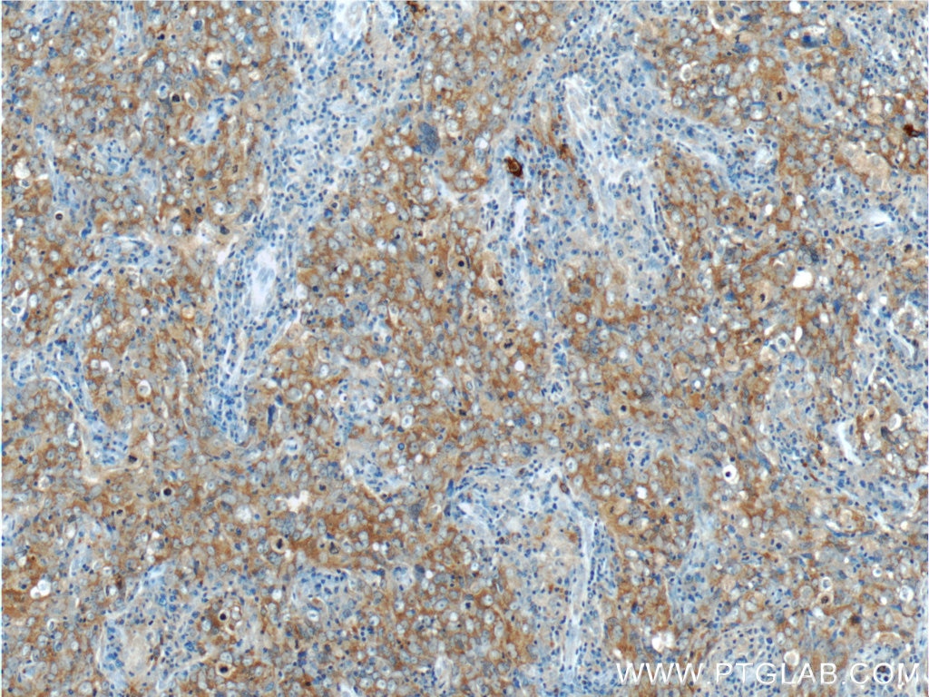 Immunohistochemistry (IHC) staining of human breast cancer tissue using ARID4B Polyclonal antibody (24499-1-AP)