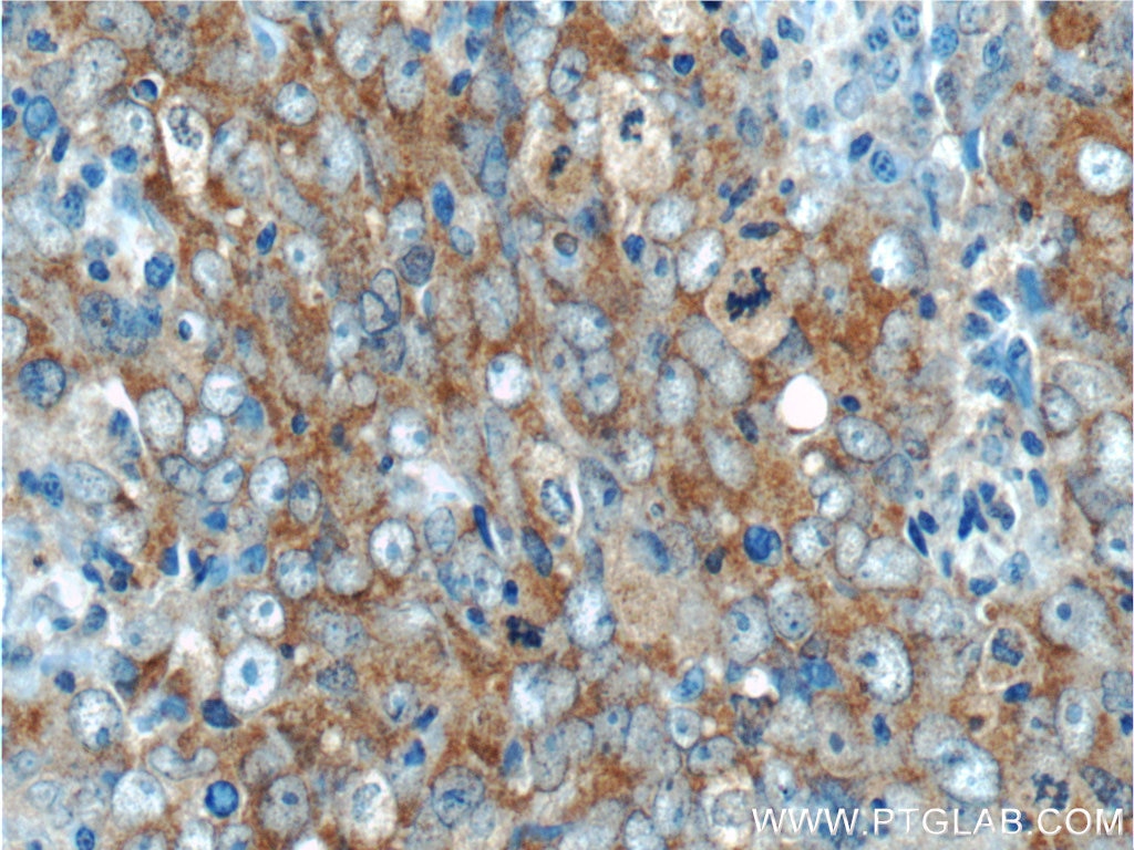 IHC staining of human breast cancer using 24499-1-AP