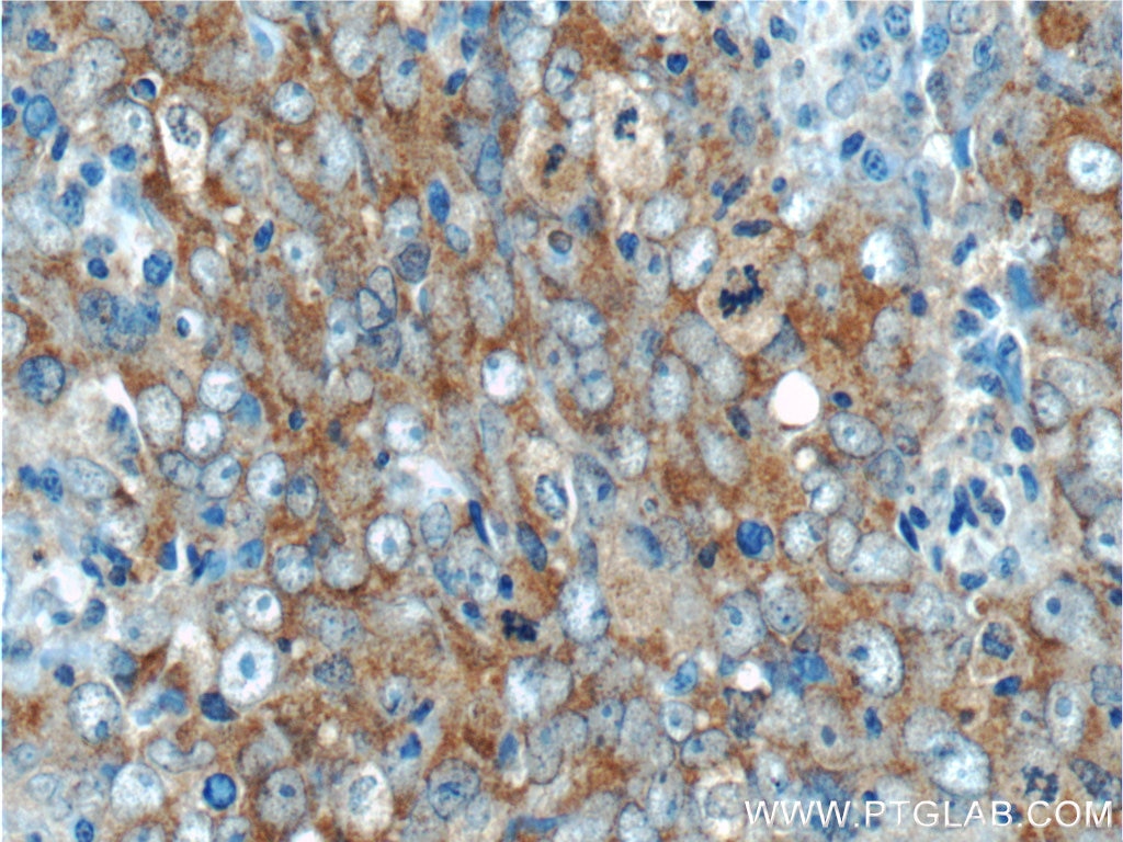 Immunohistochemistry (IHC) staining of human breast cancer tissue using ARID4B Polyclonal antibody (24499-1-AP)