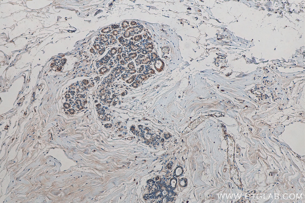 IHC staining of human breast cancer using 67384-1-Ig