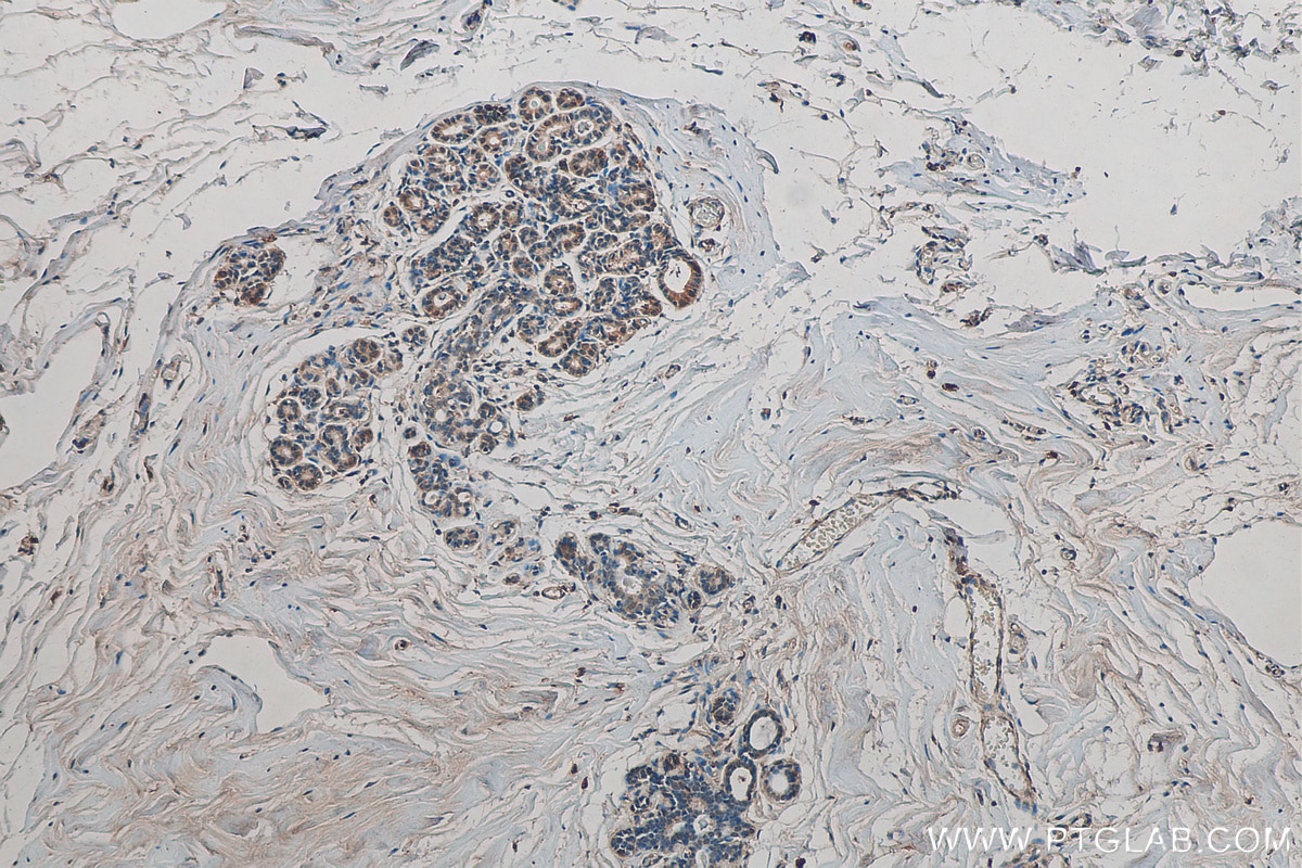 Immunohistochemistry (IHC) staining of human breast cancer tissue using ARID4B Monoclonal antibody (67384-1-Ig)