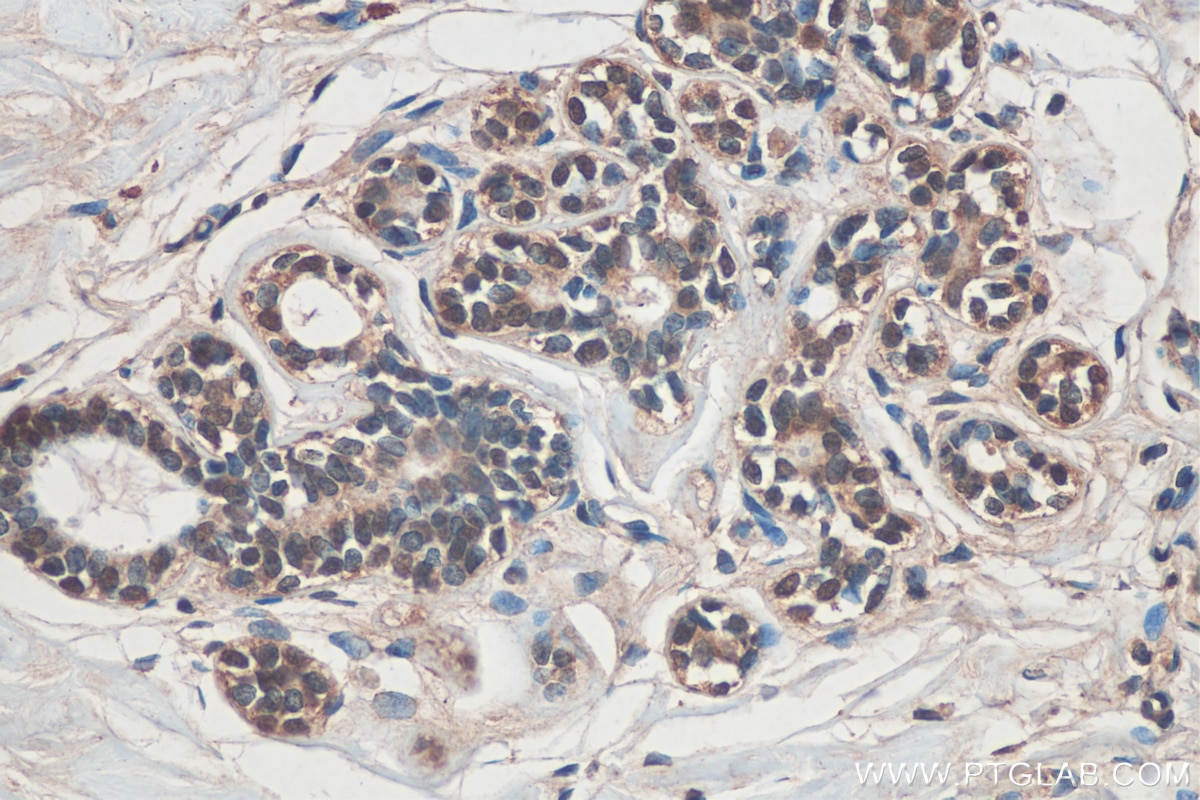 Immunohistochemistry (IHC) staining of human breast cancer tissue using ARID4B Monoclonal antibody (67384-1-Ig)