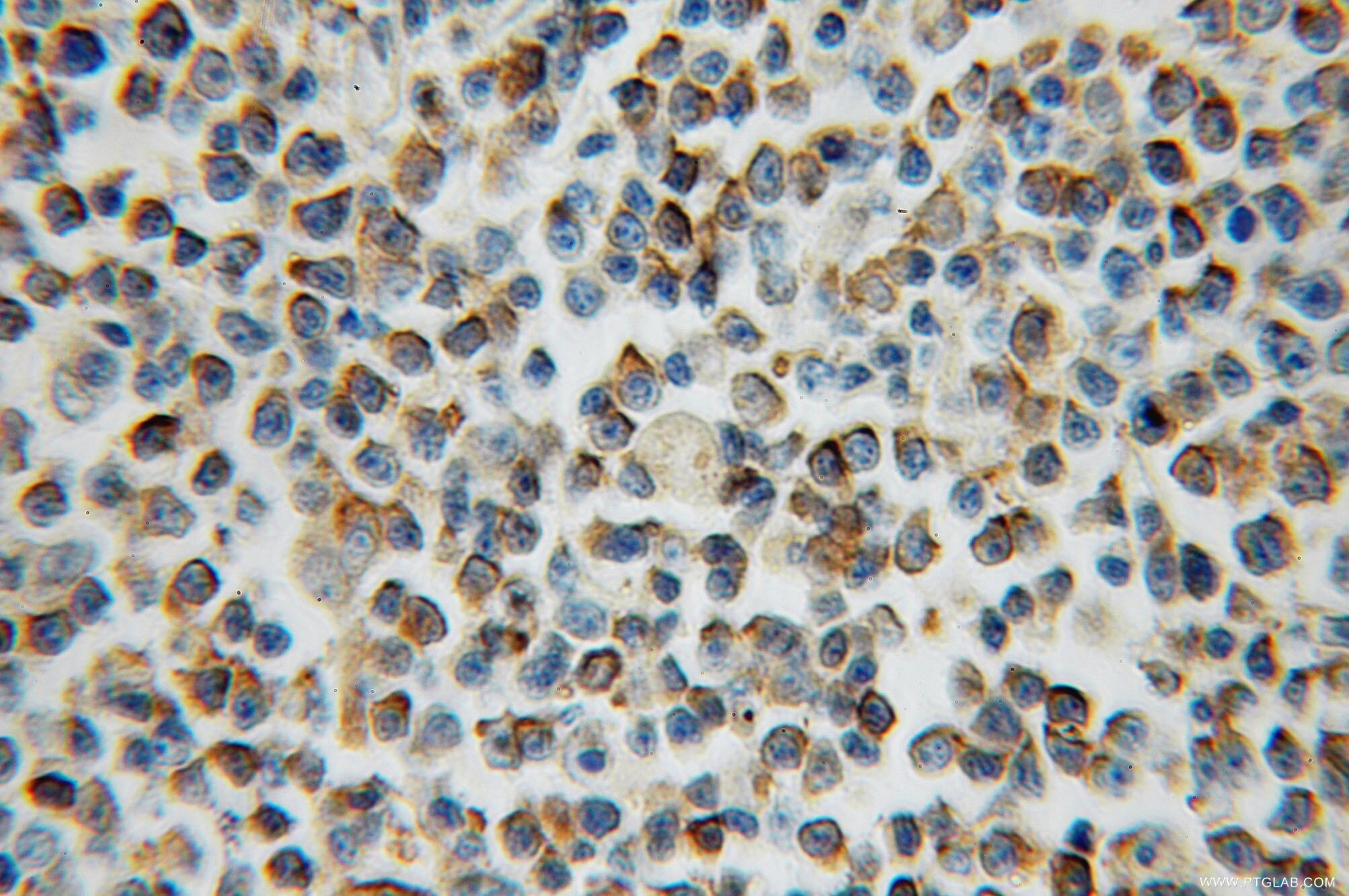 Immunohistochemistry (IHC) staining of human lymphoma tissue using ARL15 Polyclonal antibody (11934-1-AP)