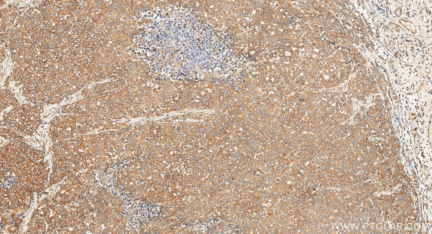 Immunohistochemistry (IHC) staining of human ovary tumor tissue using ARL2 Polyclonal antibody (10232-1-AP)