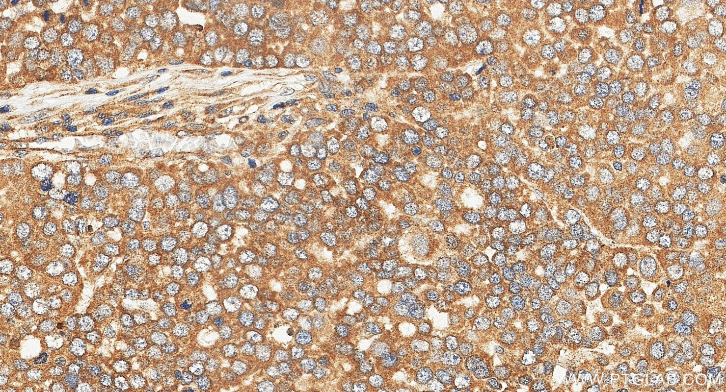 Immunohistochemistry (IHC) staining of human ovary tumor tissue using ARL2 Polyclonal antibody (10232-1-AP)