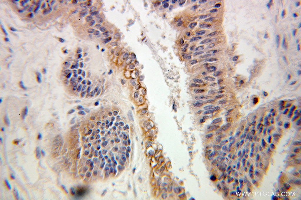 Immunohistochemistry (IHC) staining of human ovary tumor tissue using ARL2 Polyclonal antibody (10232-1-AP)