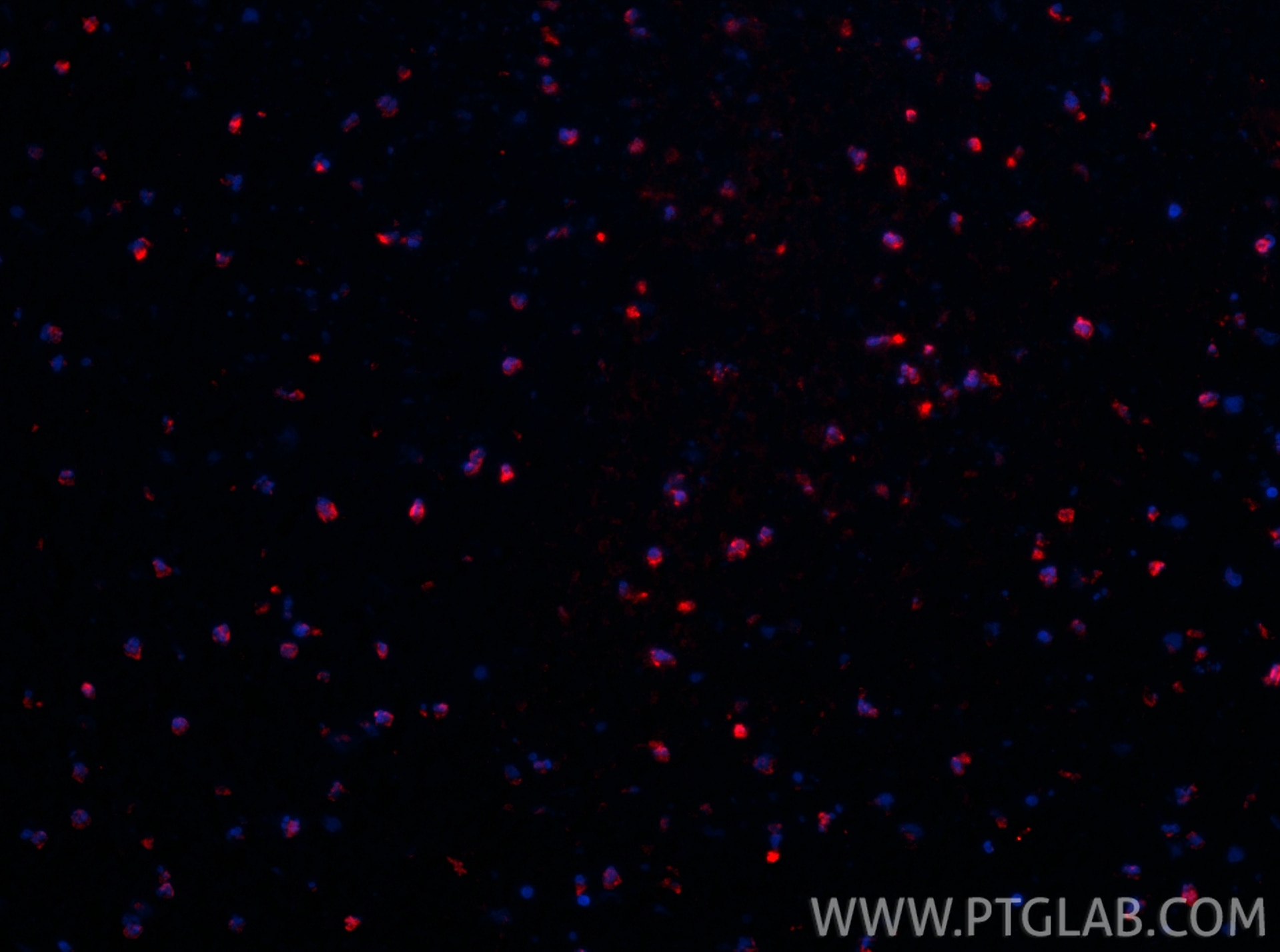 Immunofluorescence (IF) / fluorescent staining of human ovary cancer tissue using CoraLite®594-conjugated ARL2 Polyclonal antibody (CL594-10232)