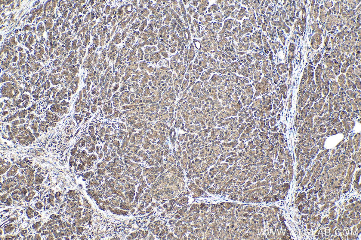 Immunohistochemistry (IHC) staining of human pancreas cancer tissue using ARL2BP Polyclonal antibody (10090-2-AP)