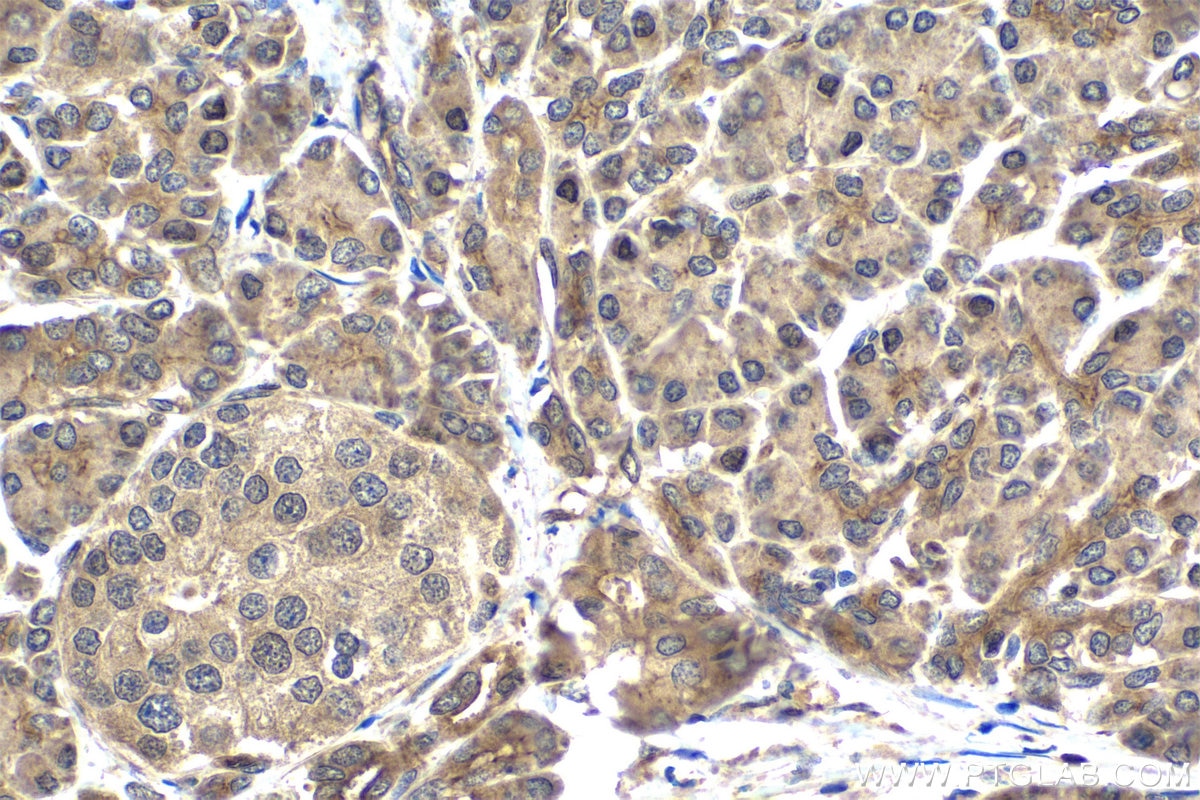 Immunohistochemistry (IHC) staining of human pancreas cancer tissue using ARL2BP Polyclonal antibody (10090-2-AP)