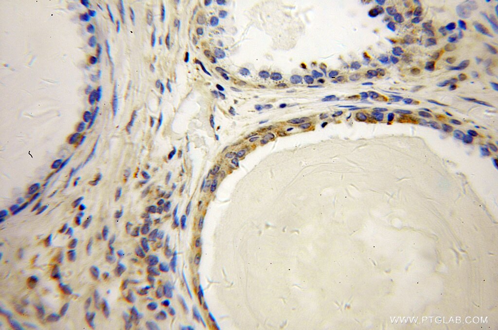 Immunohistochemistry (IHC) staining of human gliomas tissue using ARL2BP Polyclonal antibody (10090-2-AP)
