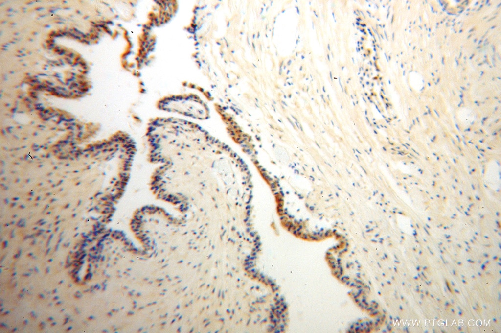 Immunohistochemistry (IHC) staining of human gliomas tissue using ARL2BP Polyclonal antibody (10090-2-AP)