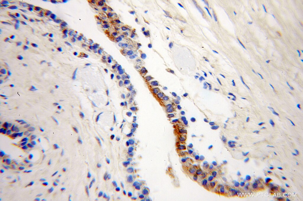 IHC staining of human gliomas using 10090-2-AP