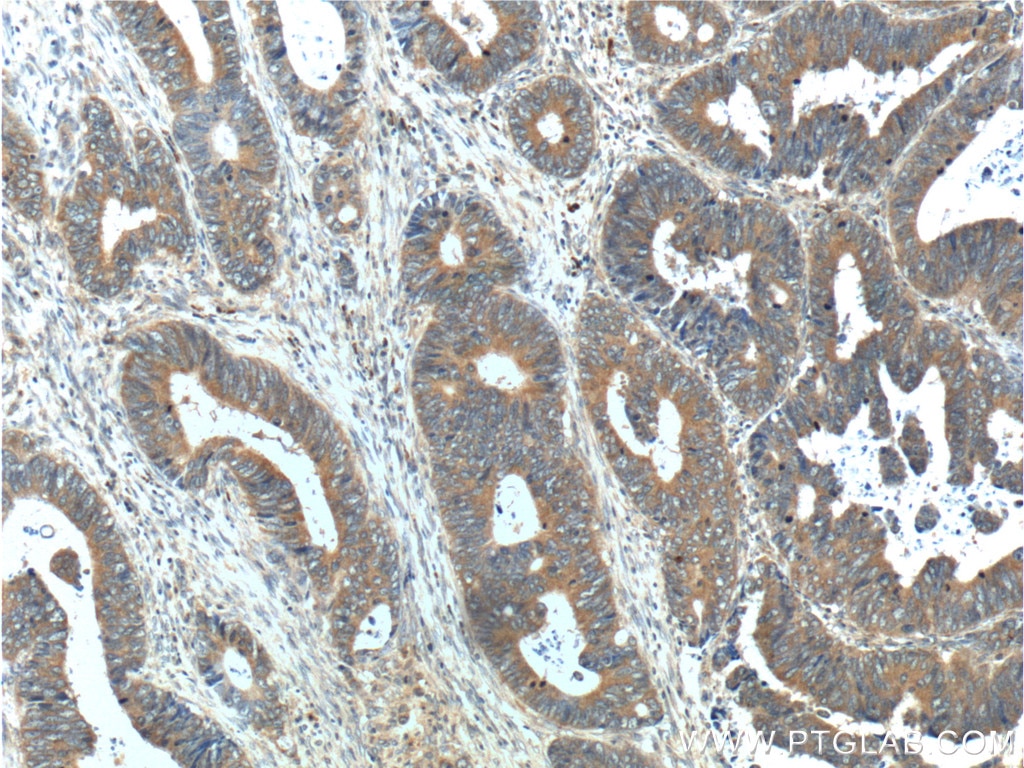 Immunohistochemistry (IHC) staining of human colon cancer tissue using ARL4C Polyclonal antibody (10202-1-AP)