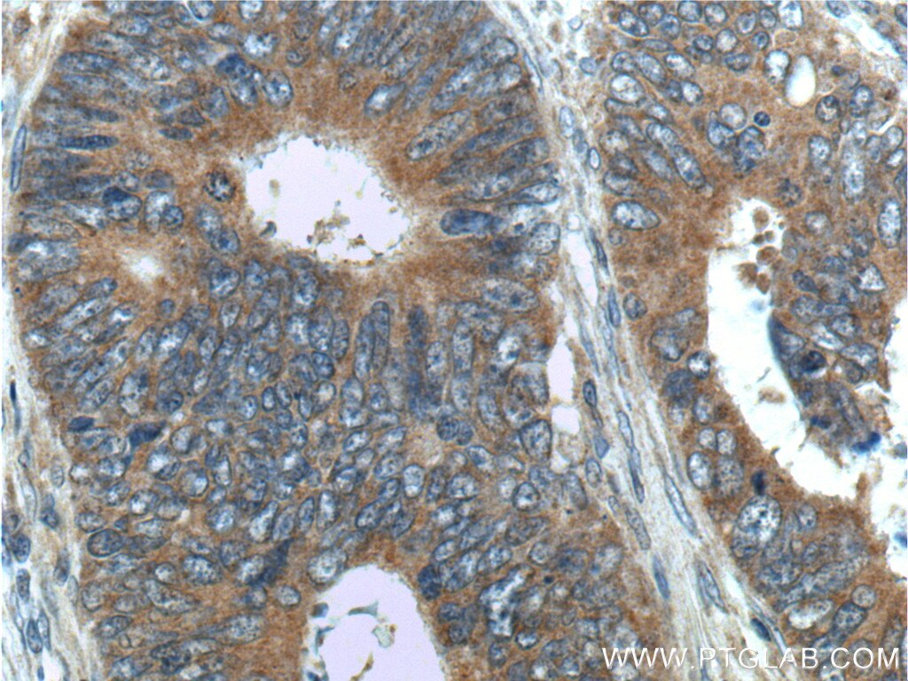 Immunohistochemistry (IHC) staining of human colon cancer tissue using ARL4C Polyclonal antibody (10202-1-AP)