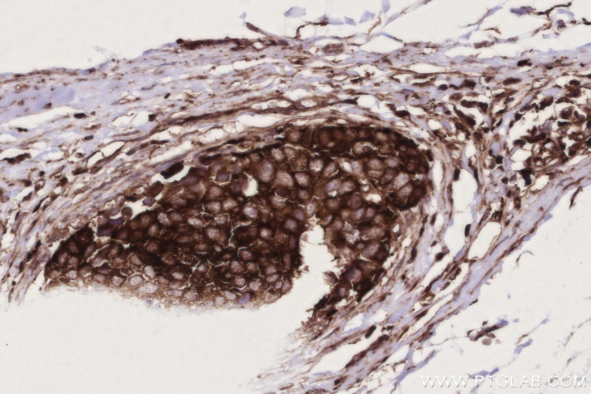 Immunohistochemistry (IHC) staining of human stomach cancer tissue using ARL8A/ARL8B Monoclonal antibody (68186-1-Ig)