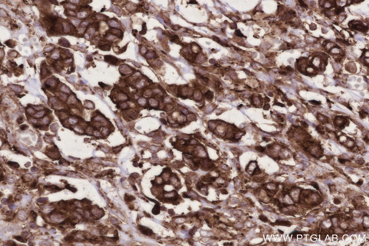 Immunohistochemistry (IHC) staining of human stomach cancer tissue using ARL8A/ARL8B Monoclonal antibody (68186-1-Ig)