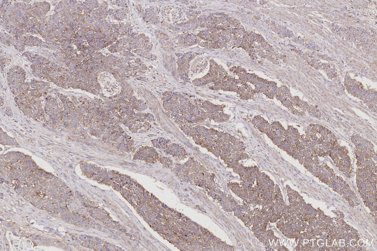 Immunohistochemistry (IHC) staining of human stomach cancer tissue using ARL8B Polyclonal antibody (13049-1-AP)