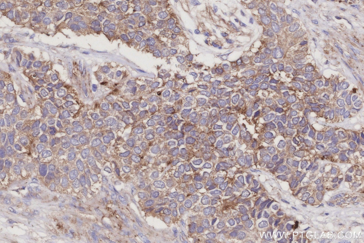 Immunohistochemistry (IHC) staining of human stomach cancer tissue using ARL8B Polyclonal antibody (13049-1-AP)
