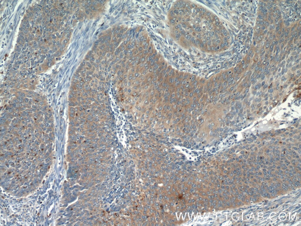 Immunohistochemistry (IHC) staining of human cervical cancer tissue using ARMC7 Polyclonal antibody (24029-1-AP)