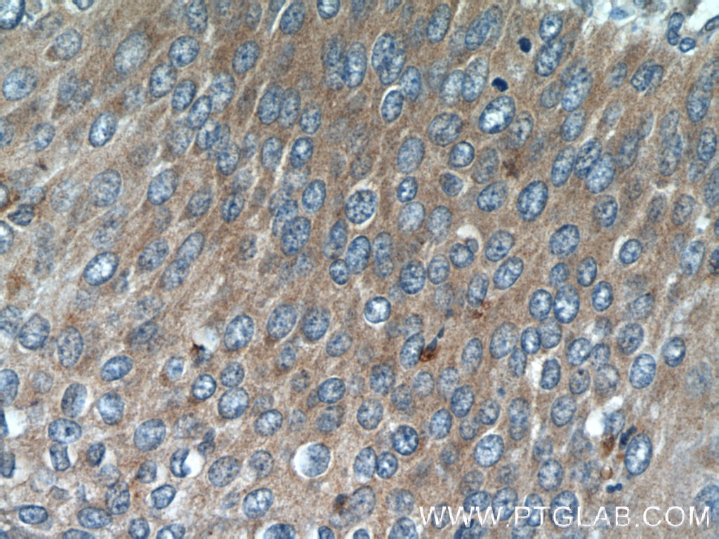 Immunohistochemistry (IHC) staining of human cervical cancer tissue using ARMC7 Polyclonal antibody (24029-1-AP)