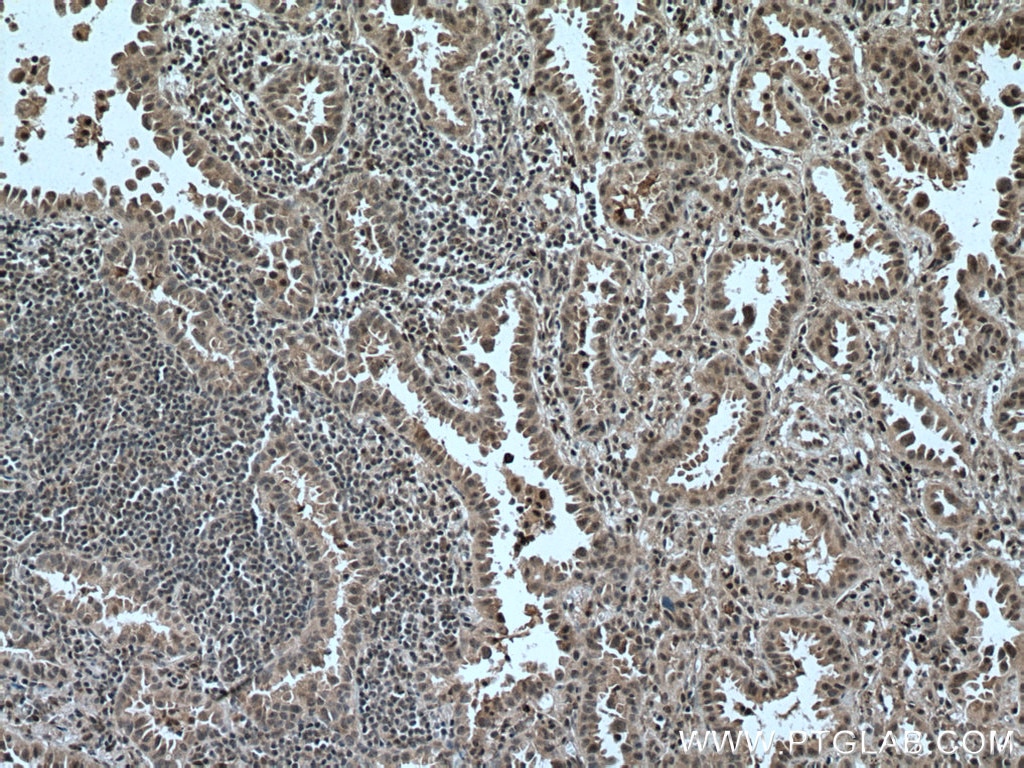 Immunohistochemistry (IHC) staining of human lung cancer tissue using ARMC8 Polyclonal antibody (12653-1-AP)