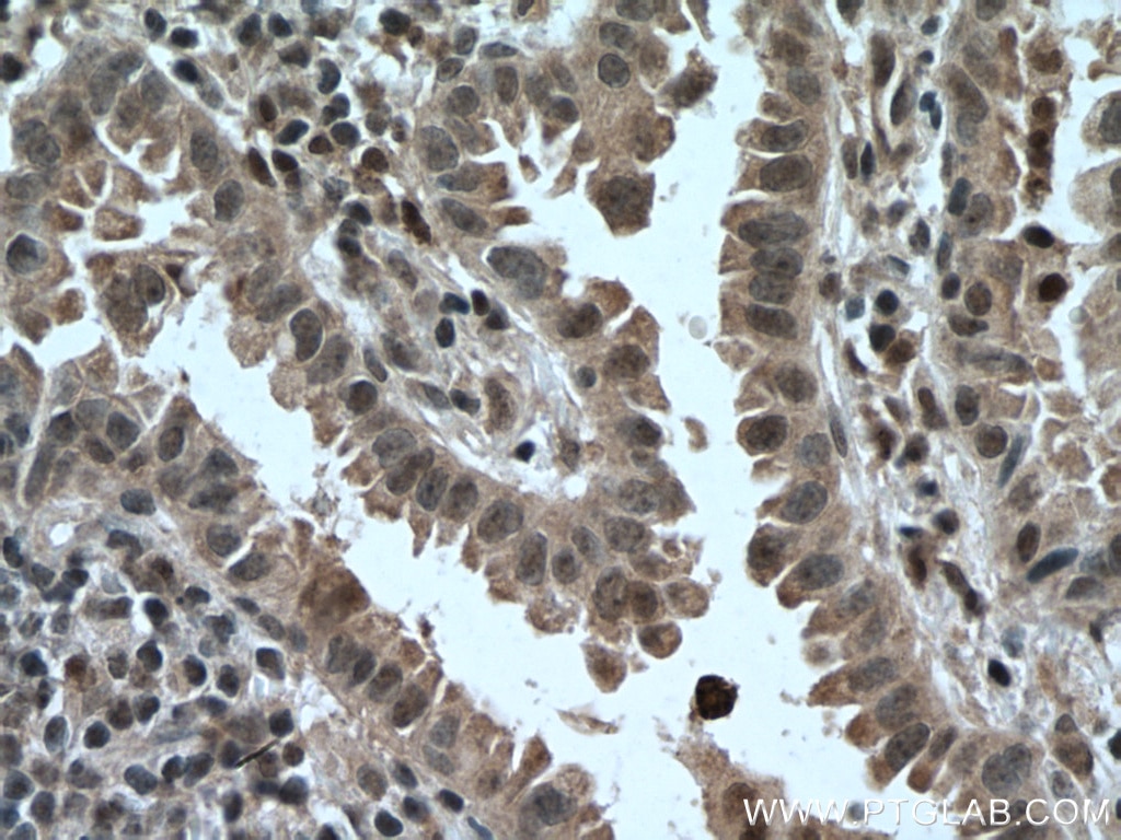 Immunohistochemistry (IHC) staining of human lung cancer tissue using ARMC8 Polyclonal antibody (12653-1-AP)