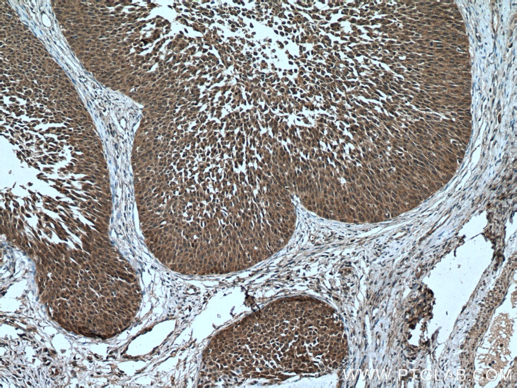 Immunohistochemistry (IHC) staining of human cervical cancer tissue using ARMC8 Polyclonal antibody (12653-1-AP)