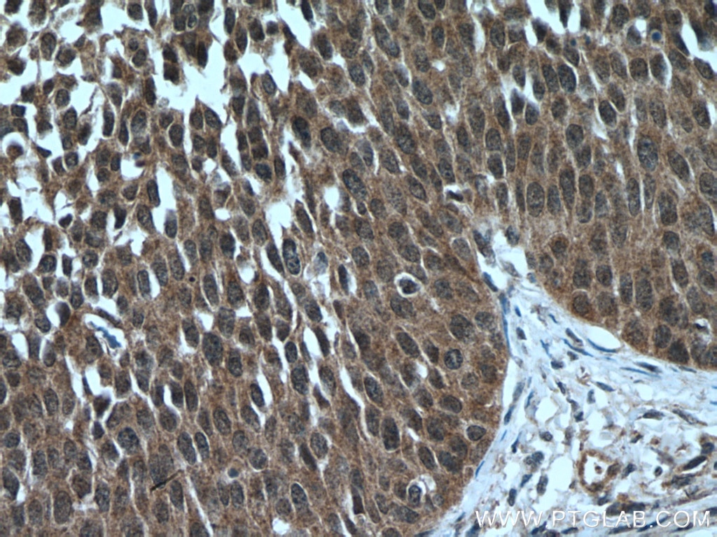 Immunohistochemistry (IHC) staining of human cervical cancer tissue using ARMC8 Polyclonal antibody (12653-1-AP)