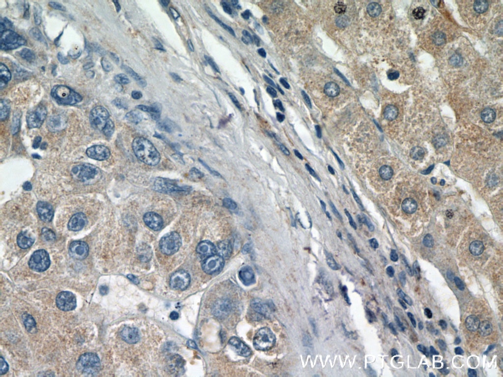 IHC staining of human liver cancer using 25035-1-AP