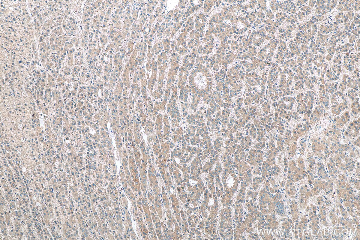 Immunohistochemistry (IHC) staining of human liver cancer tissue using ARMETL1 Polyclonal antibody (25035-1-AP)