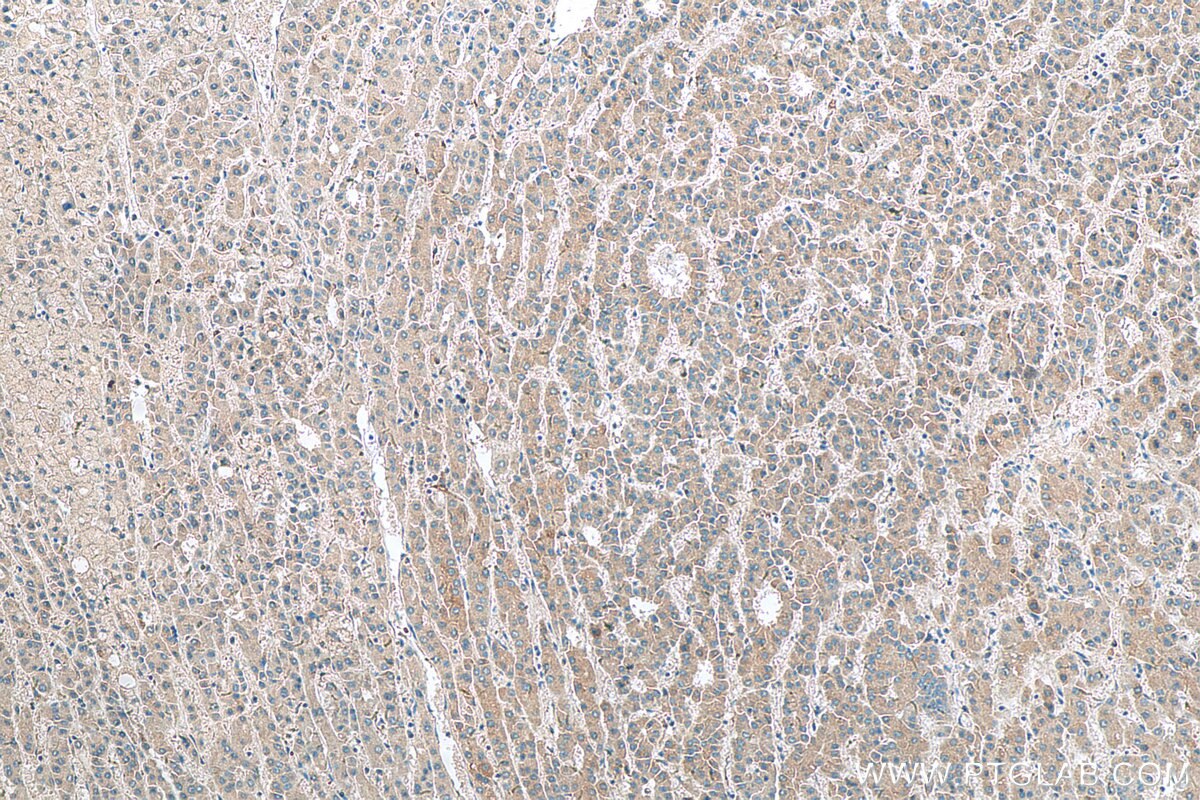 Immunohistochemistry (IHC) staining of human liver cancer tissue using ARMETL1 Polyclonal antibody (25035-1-AP)