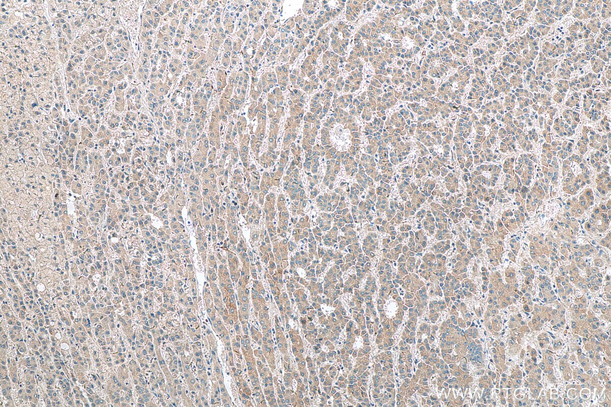 IHC staining of human liver cancer using 25035-1-AP