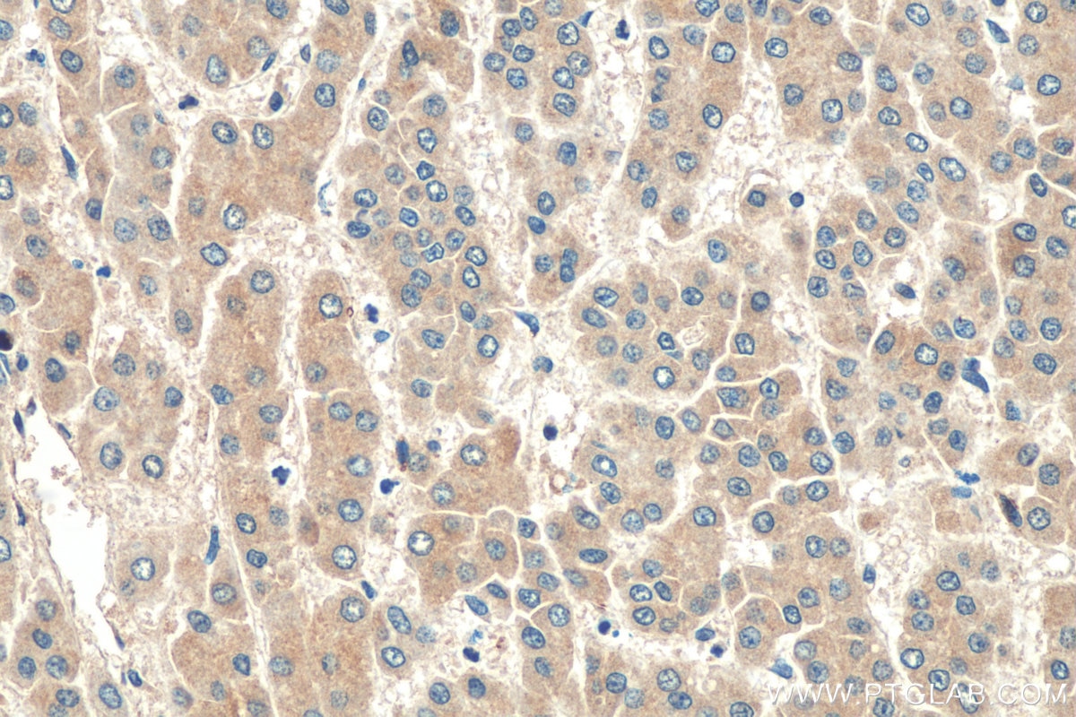 Immunohistochemistry (IHC) staining of human liver cancer tissue using ARMETL1 Polyclonal antibody (25035-1-AP)