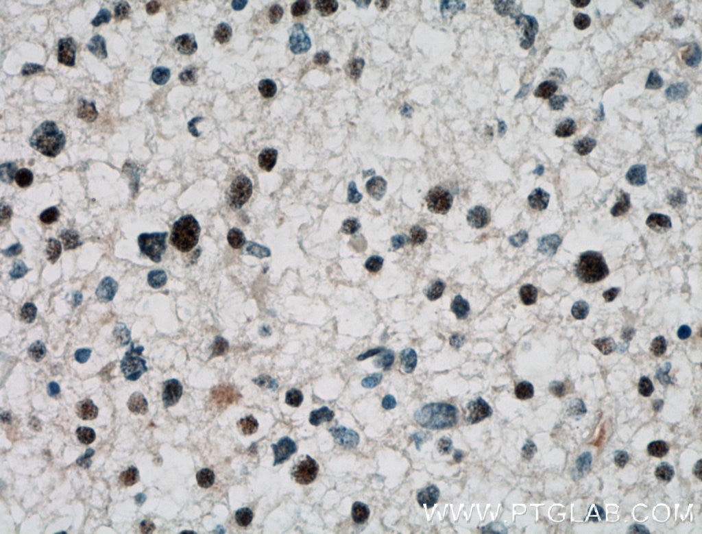 IHC staining of human gliomas using 12810-1-AP