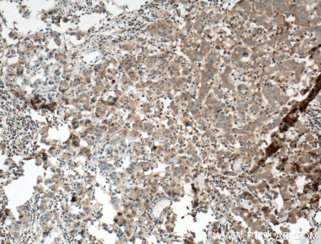 Immunohistochemistry (IHC) staining of human prostate cancer tissue using ARNTL Polyclonal antibody (14268-1-AP)