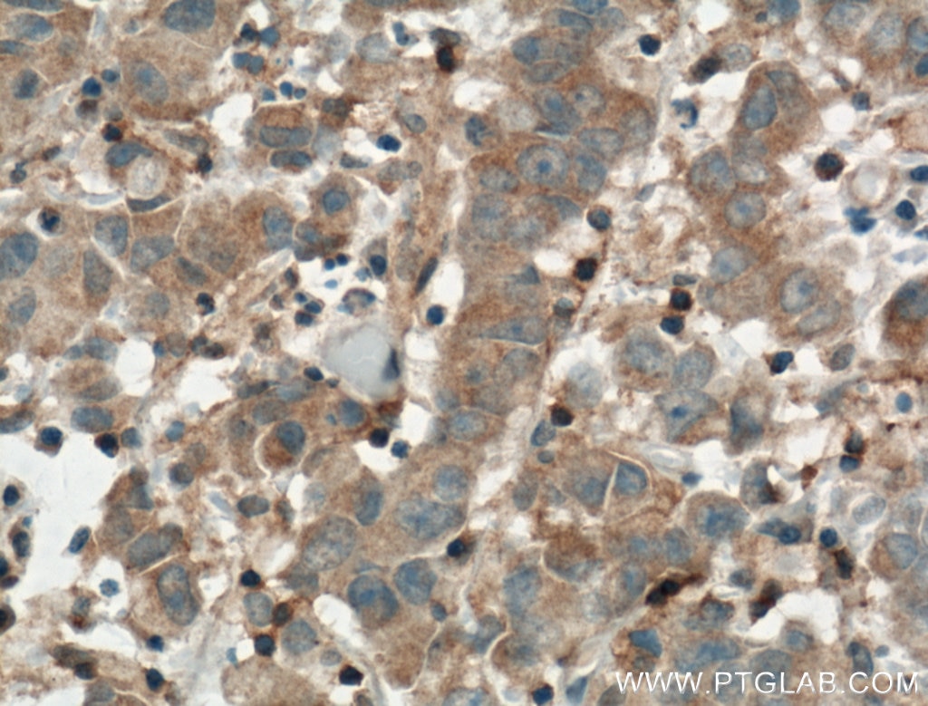 Immunohistochemistry (IHC) staining of human prostate cancer tissue using ARNTL Polyclonal antibody (14268-1-AP)