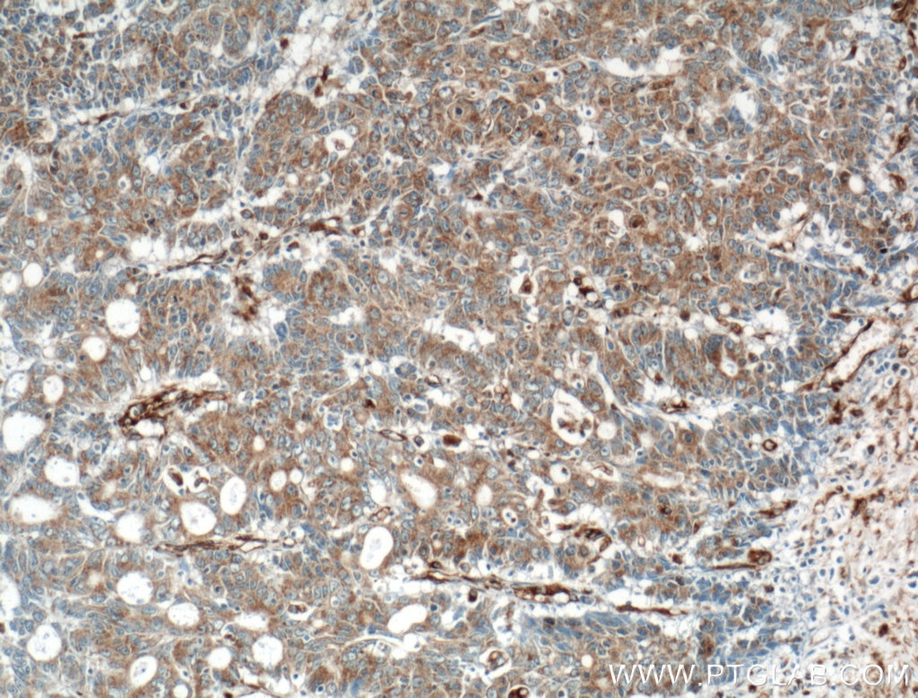 Immunohistochemistry (IHC) staining of human colon cancer tissue using ARNTL Polyclonal antibody (14268-1-AP)