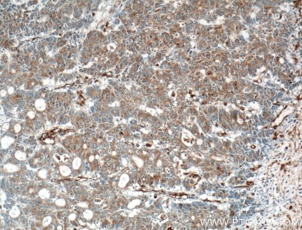 IHC staining of human colon cancer using 14268-1-AP