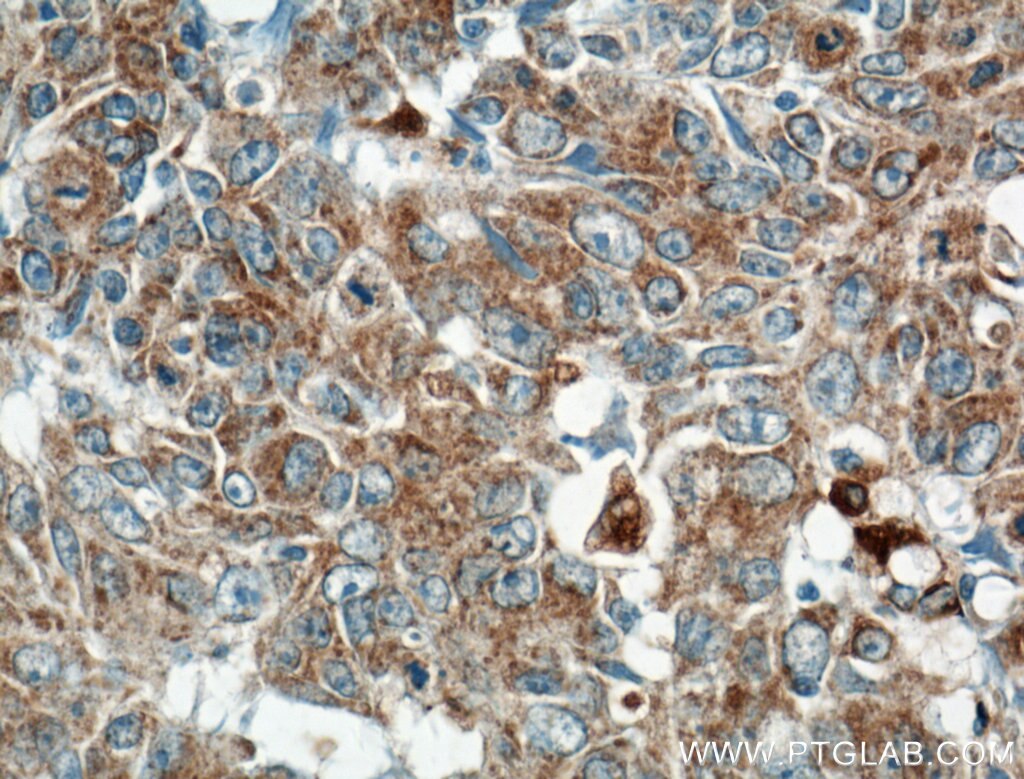 Immunohistochemistry (IHC) staining of human colon cancer tissue using ARNTL Polyclonal antibody (14268-1-AP)